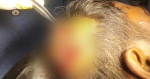 सामान्य विवादको कारण झगडा हुदा एक जना गम्भीर घाइते