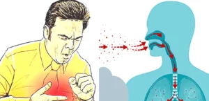 एउटै वडामा भेटिए क्षयरोगका २५ सङ्क्रमित